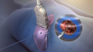Photo of Everything you need to know about  Radiofrequency ablation (RFA)